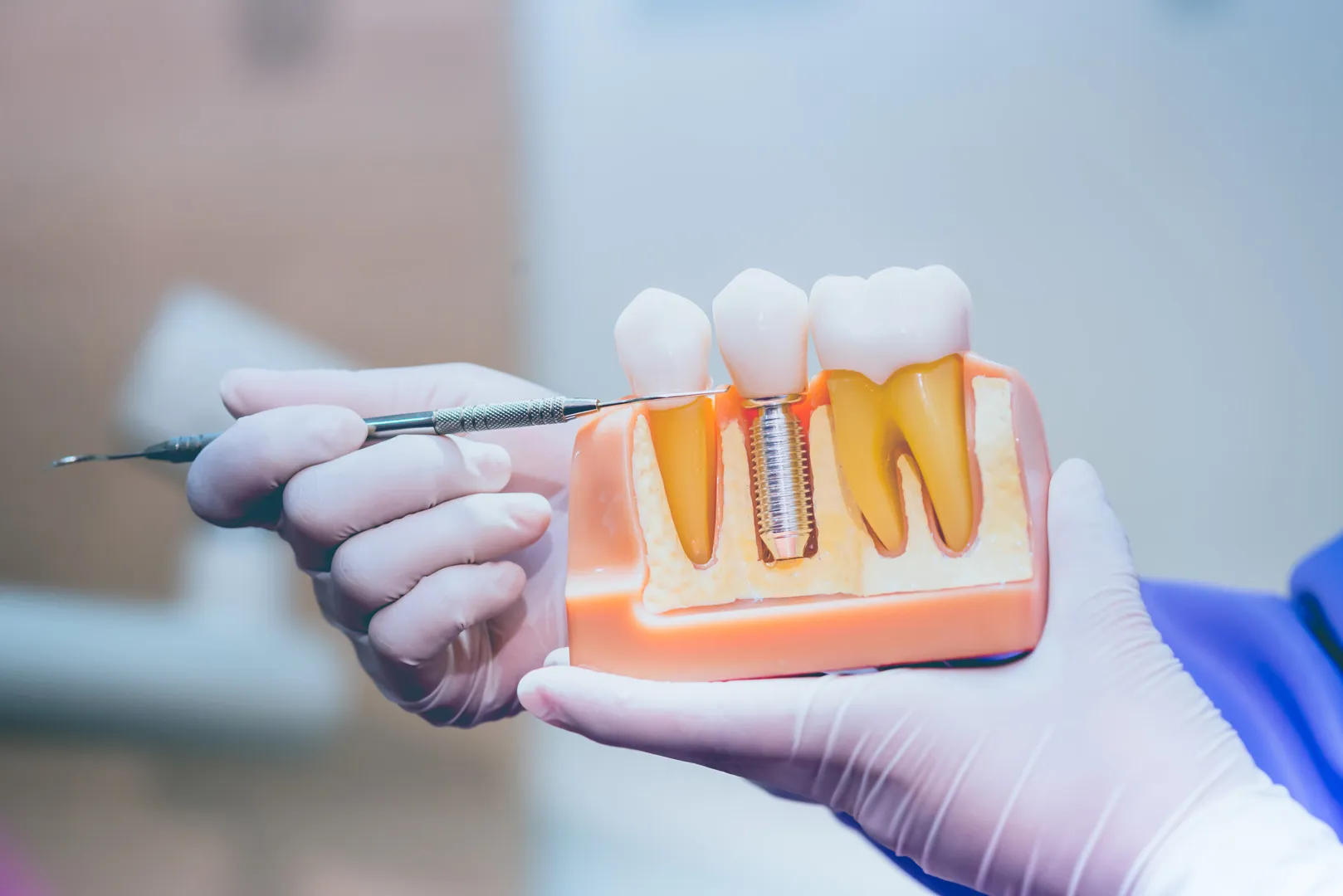 Dental Implants in South Lake Tahoe